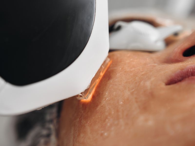 IPL facial